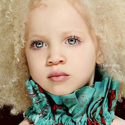 Афроамериканка-альбинос стала популярной моделью